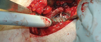 Illustration 43 for Unlock the Figure Posterior Approach to the Hip