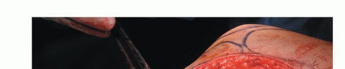 Illustration 34 for Beyond Amputation: The Type I Resection in Fibular Tumor Surgery