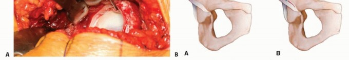 Illustration 14 for Surgical Hip Dislocation Safety: The Branch of the MFCA's Vital Role