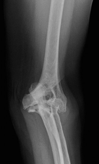 Illustration 83 for Right Shoulder Pain? Avoid This Common X-ray Mistake.