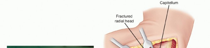 Illustration 17 for Radial Head Arthroplasty: Restoring Elbow Function & Stability