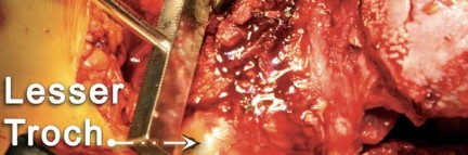 Illustration 71 for Birmingham Hip Resurfacing Designer's Technique for Active Lives