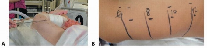 Illustration 8 for Anterior Interbody Arthrodesis for Scoliosis: What You Need to Know
