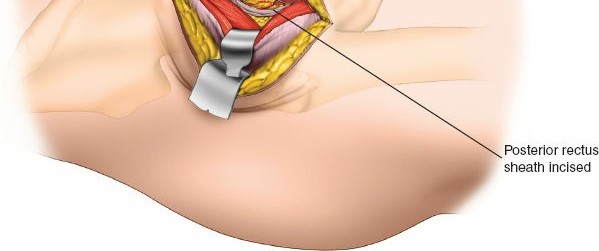 Illustration 90 for Unlocking Every Aspect of the Hip's Surgical Approaches