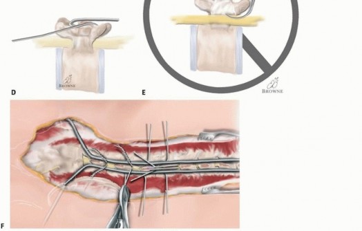 Illustration 18 for Duchenne Muscular Dystrophy: Is Spinal Fusion the Answer?