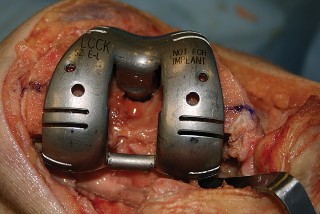Illustration 24 for Understand Augments: The Role of Metal Augments in Arthroplasty