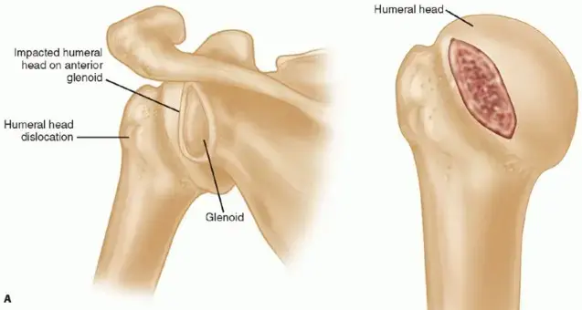 صورة توضيحية لـ وداعاً لآلام الكتف المزمنة: دليل شامل لعدم استقرار مفصل الكتف وفقدان العظم