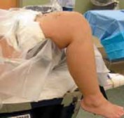 Illustration 4 for Knee Arthroplasty Unicondylar: Discover if Partial Knee Replacement is Right