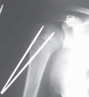 Illustration 22 for Mastering Pediatric Shoulder Fractures: Clinical Insights