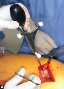 Illustration 11 for Avoiding Errors: Navigation in Total Hip Arthroplasty