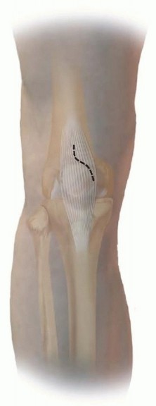 Illustration 25 for Advanced Nailing of the Mature Tibia: Overcoming Complexities