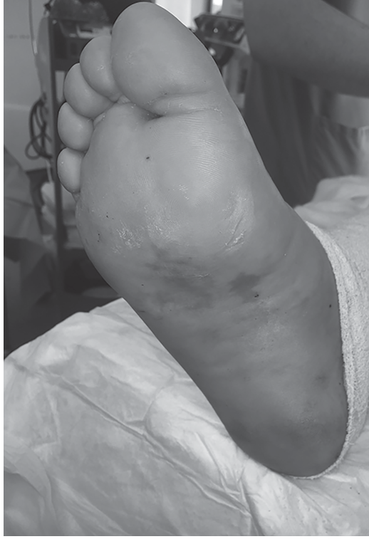 Illustration 2 for Decode a Lisfranc Injury Case: Diagnosis & Clinical Pearls