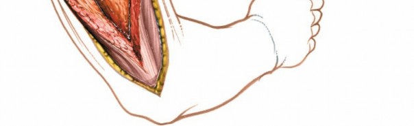 Illustration 43 for Mastering the Approach to the Distal Humerus: Safety & Skills