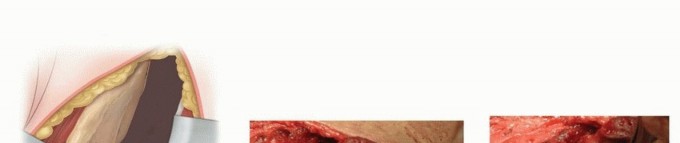 Illustration 16 for Mastering Anterior Open Reduction for Developmentally Dislocated Hip