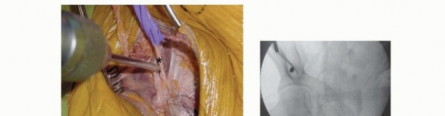 Illustration 22 for Emergency Fixation of the Pelvis: Control Bleeding & Restore Stability