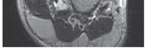 Illustration 11 for Medial Ankle Instability: Find Relief with Reconstruction