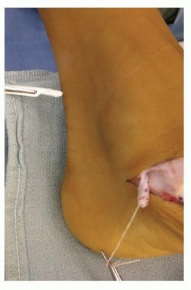 Illustration 12 for Calcaneal Lengthening Osteotomy: Correcting Hindfoot Valgus