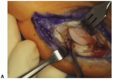 Illustration 16 for Restore Your Foot: Surgical Treatment for Hallux MP Joint Turf Toe