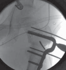 Illustration 26 for Increased Femoral Anteversion: A Proximal Femoral Rotational Osteotomy