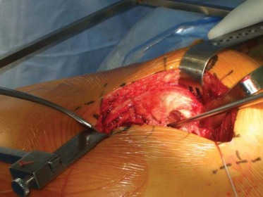 Illustration 70 for Successful Total Hip Replacement in Developmental Dysplasia