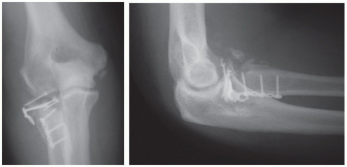 Illustration 48 for Radial Head & Neck Fractures: Mastering ORIF for Best Results