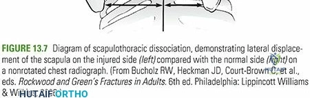 Illustration of scapulothoracic dissociation scapulothoracic - Dr. Mohammed Hutaif