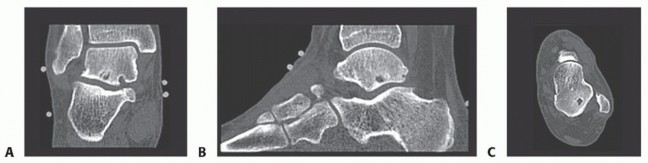 Illustration 2 for Posterior Talar Process: Endoscopic Solutions for Ankle Pain