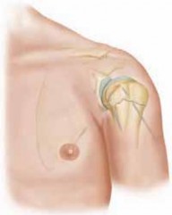 Illustration 15 for Mastering Pediatric Shoulder Fractures: Clinical Insights