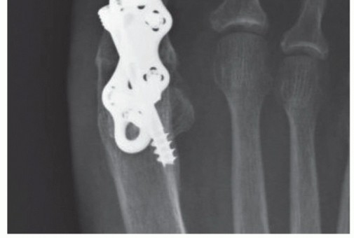 Illustration 12 for MTP Joint Arthrodesis: The Key to Optimal Toe Positioning