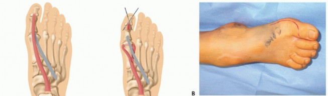 Illustration 24 for How Achilles Tendon Lengthening Fixes Equinocavovarus Foot