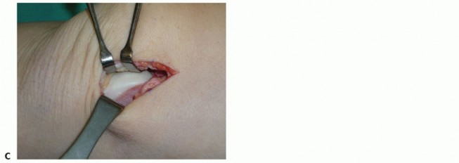 Illustration 22 for Painful Talus Lesions? The tech fig c Osteochondral Transfer Solution