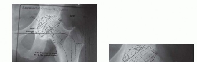 Illustration 3 for Cemented Total Hip: A Successful & Evidence-Based Solution