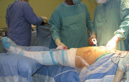 Illustration 53 for Figure Hip Resurfacing: Who Benefits and Who Should Avoid It?