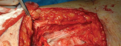 Illustration 2 for Femoral Stem Revision: Posterior Approach for Better Outcomes