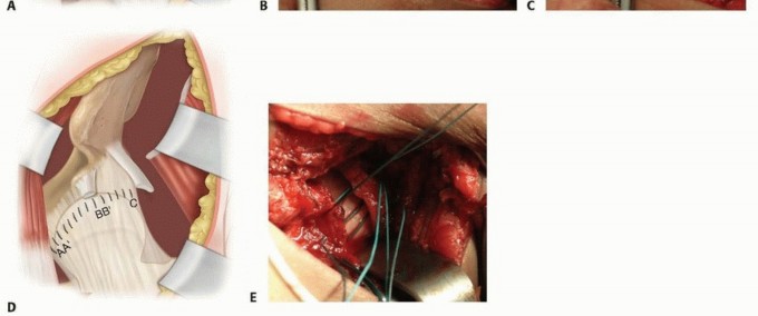 Illustration 18 for Mastering Anterior Open Reduction for Developmentally Dislocated Hip
