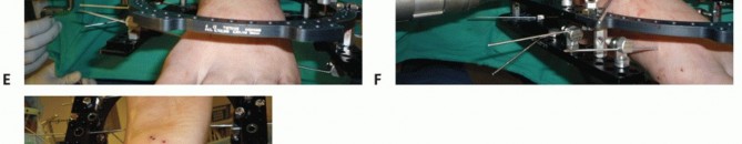 Illustration 47 for Optimize Pain Management with Proximal Ring Block for Ankle Arthrodesis