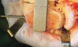 Illustration 29 for Mastering TKA: Essential Methods of Rotational Alignment