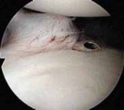 Illustration 18 for Regain Stability: Anterior Shoulder Instability Arthroscopic Fix