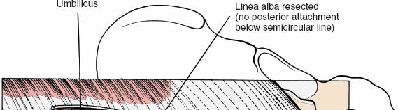 Illustration 100 for Approach to the Lumbar Spine: Mastering Techniques & Anatomy