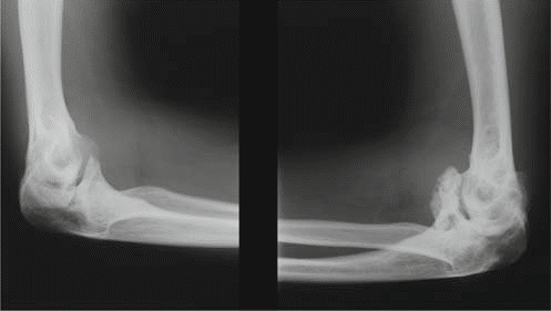 Illustration 7 for Understanding Multiple Epiphyseal Dysplasia: Orthopedic Cases