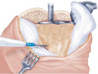 Illustration 33 for Precision Soft Tissue Balancing in Revision: Avoid TKA Pitfalls