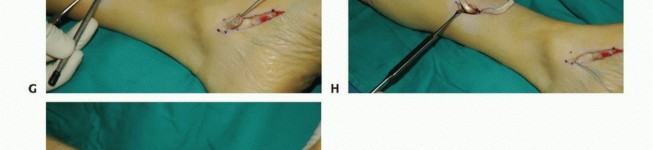 Illustration 28 for Foot Drop Surgery: How a Pin or Drill Elevates Tendon Transfer