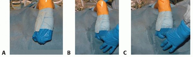 Illustration 11 for Posterior Talar Process: Endoscopic Solutions for Ankle Pain