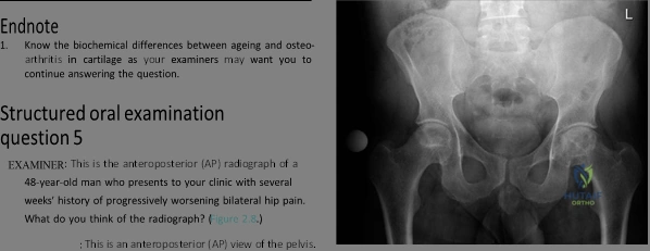 Illustration of femoral head affected - Dr. Mohammed Hutaif