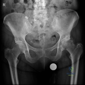 Illustration 1 for Is Your Femoral Head Affected? Understanding Hip Osteoarthritis