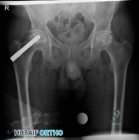Illustration 3 for Is Your Femoral Head Affected? Understanding Hip Osteoarthritis