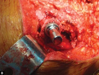 Illustration 63 for The Silent Hip: Achieving a Truly Silent, Pain-Free Joint