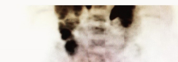 Illustration 5 for Beyond Hemipelvectomy: Preservation of the Sciatic in Buttock Surgery