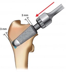 Illustration 64 for The Silent Hip: Achieving a Truly Silent, Pain-Free Joint
