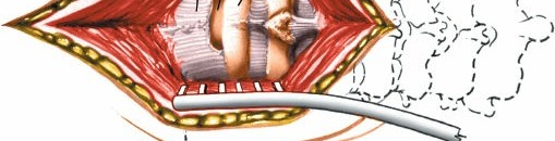 Illustration 232 for Approach to the Lumbar Spine: Mastering Techniques & Anatomy